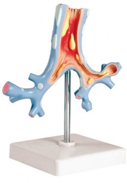 Modell Bronchialerkrankungen